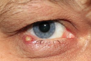 Symptoms of trachoma